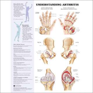 Understanding Arthritis, Anatomical Chart/Charts/Model  